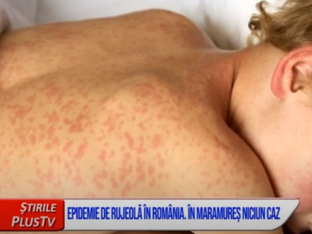 EPIDEMIE DE RUJEOLĂ ÎN ROMÂNIA. ÎN MARAMUREȘ, NICIUN CAZ