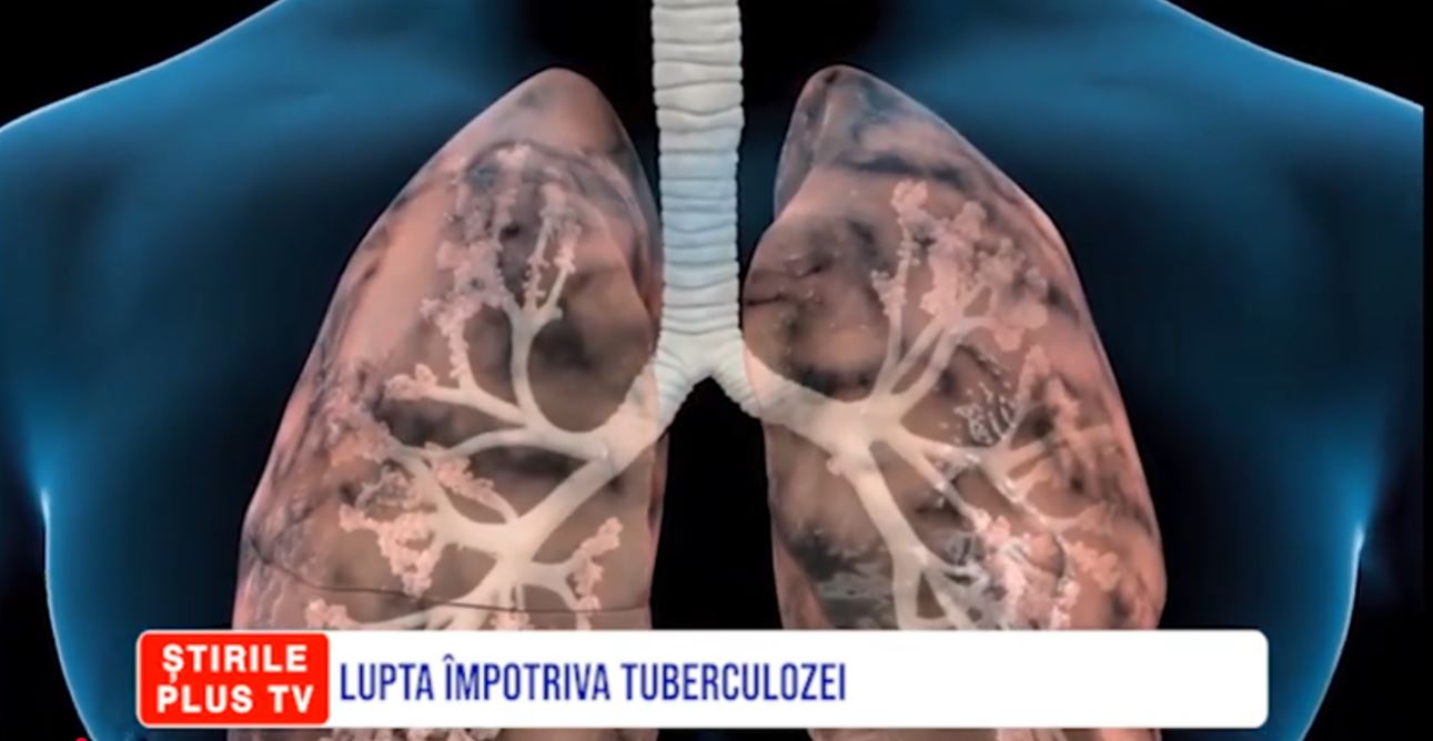 LUPTA ÎMPOTRIVA TUBERCULOZEI